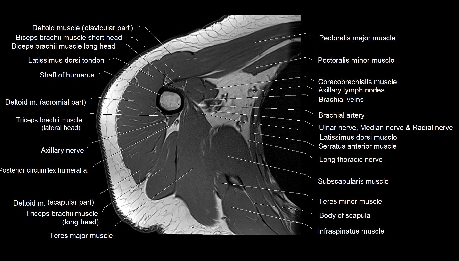 Shoulder cross sectional anatomy MRI 3T axial image 37.webp